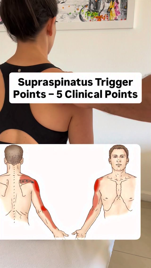 Supraspinatus
1. Location: Trigger points are typically found in the supraspinatus muscle belly within the supraspinous fossa of the scapula.
2. Referred Pain Pattern: Pain is referred to the lateral shoulder, deltoid region, and sometimes the lateral arm.
3. Functional Limitation: Patients may present with painful initiation of shoulder abduction (first ~15°).
4. Palpation Findings: Taut bands and hypersensitive nodules can be palpated, often reproducing the patient’s referred pain.
5. Associated Conditions: Commonly associated with rotator cuff dysfunction, shoulder impingement syndrome, and repetitive overhead activities
#massagetherapy #stretchtherapy #massagetherapist #triggerpoint #triggerpointtherapy