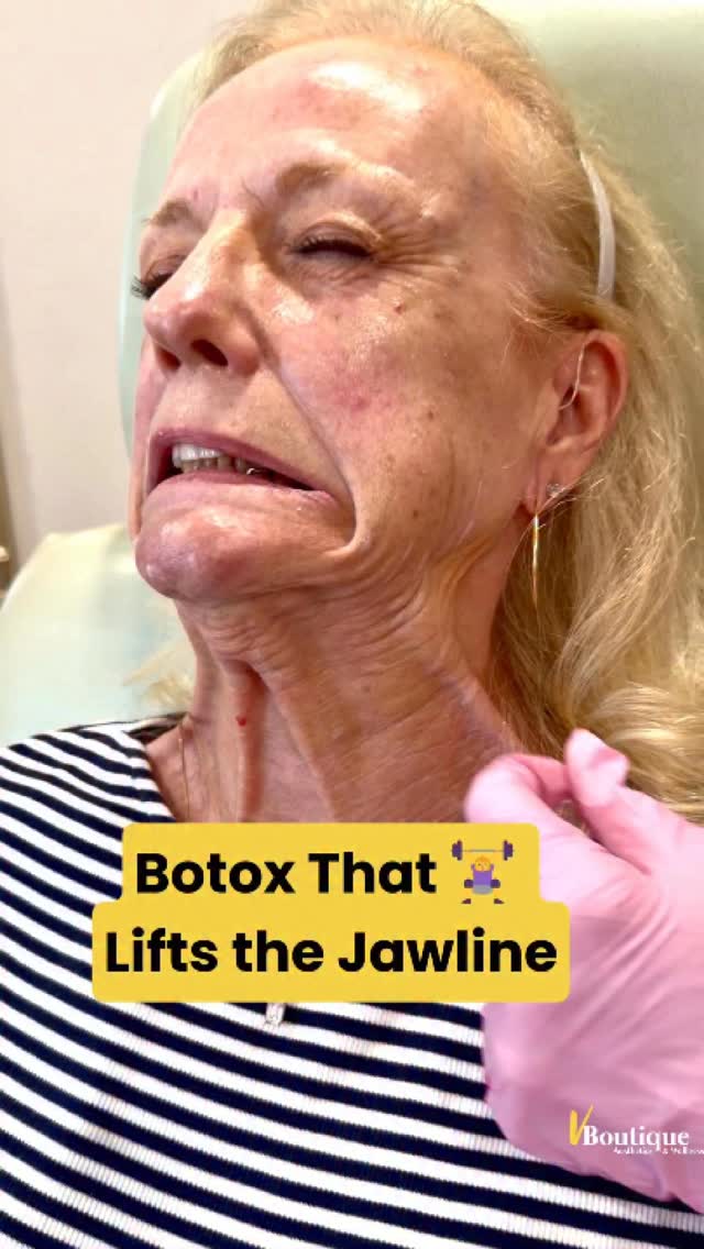 ✨ Strong neck bands can actually pull your face down!
These are called platysmal bands — vertical muscles in the neck that become stronger and more visible with age as neck fat diminishes and skin loses elasticity.
These muscles extend along the jawline like a sheet, and when they contract they pull downward☹️ on the lower face, contributing to:
▫️ Jawline sagging
▫️ Marionette lines
▫️ Radial cheek lines
▫️ Neck wrinkling
💉 By strategically injecting Botox / Dysport into the platysma and along the jawline — a technique known as the Nefertiti Lift — we relax the downward pull of these muscles😊.
When the depressor muscles are weakened, the facial elevator muscles work more effectively, which can lead to:
✨ Sharper jawline
✨ Smoother neck
✨ Softening of marionettes
✨ Subtle lifting of the midface
📚 Studies of the Nefertiti lift show improved jawline definition and lifting due to restoration of the balance between facial elevators and depressors.
⏳ We’ll post her before & after in a couple weeks — stay tuned!
#BotoxNeckLift #NefertitiLift #PlatysmaBands #JawlineRejuvenation #AestheticInjector