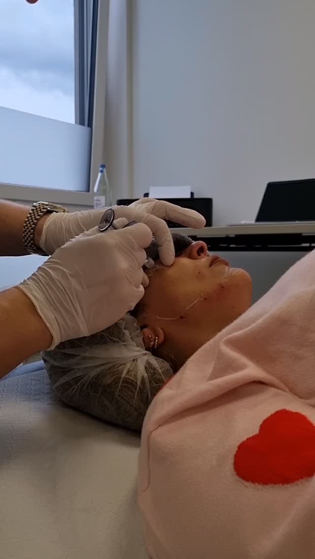 Fullface Behandlung mit Hyaluronsäure 💉