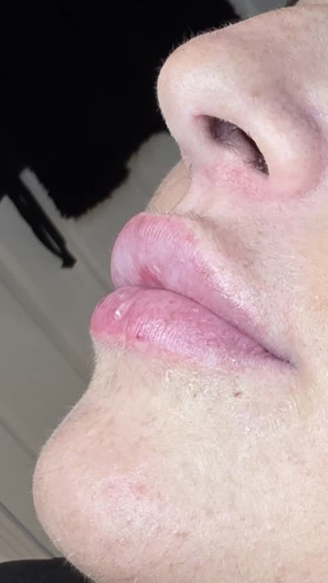 1ml can make all the difference 💉✨
We added 1ml for this client and achieved a fuller, more balanced look while keeping everything natural and soft. Subtle enhancements, beautiful results.
Less can truly be more 🤍
If you’ve been thinking about a little refresh, this is your sign.
#1ml #LipFiller #NaturalResults #AestheticClinic #SubtleEnhancement ConfidenceBoost
