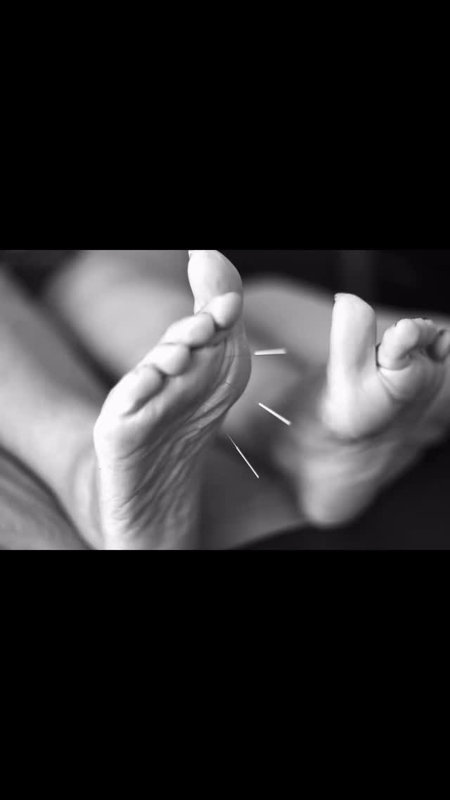 The needles 🪡 I use are super thin, It’s truly strange how little you notice them. I often tell people it’s like when you pull a hair out of your head, you feel it but it’s not a big deal 😜#i❤️acupuncture #acupunctureforthepeople #i❤️acupuncture #acupuncturenz #acupuncture