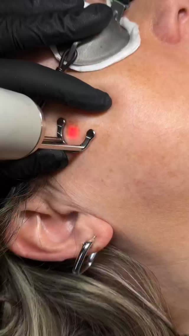 ✨ Say goodbye to stubborn dark spots! ✨
Laser treatments can help target pigmentation, revealing a brighter, more even complexion. Safe, precise, and designed to refresh your skin with minimal downtime.
Ready to glow with confidence? Your clear-skin journey starts here. 💫
#LaserSkinTreatment #DarkSpotRemoval #HyperpigmentationTreatment #SkinRejuvenation #LaserFacial #EvenSkinTone #GlowUpSkin #AdvancedSkincare #MedicalAesthetics #SkinClinic #HealthySkinJourney #ConfidentSkin #permanentbeautybyieva #oshawa #oshawamoms
Permanent Makeup Services, T
attoo Removal & Carbon Laser Facial
⬆️Book apt with the link in bio
✨Free Consultation available
📍Oshawa, Ontario
✉️browsbyieva@gmail.com
☎️416-804-6749
Website:
permanentbeautybyieva.com