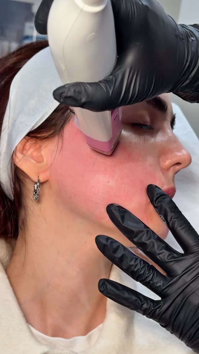 Radiofrequency Microneedling (RFM) is one of the most effective treatments for improving skin texture, tightening the skin and stimulating collagen production. ✨
It helps to reduce fine lines, acne scars, enlarged pores and overall skin laxity while giving the skin a smoother, firmer and more radiant appearance.