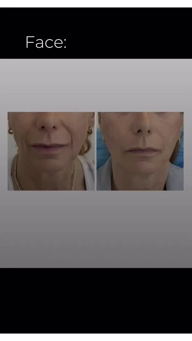 #PDOThreadsNaples
• Immediate Lifting Effect
• Collagen Stimulation
• Natural and Progressive results
• Minimal Invasive Process
• Minimal Down Time
• Long-term skin rejuvenation
Ready for the ultimate
rejuvenation experience?
Call 239-777-5002
.
.
.
.
.
.
#medicalaestheticsnaples #injectablesnaples #medspanaples #botoxnaples