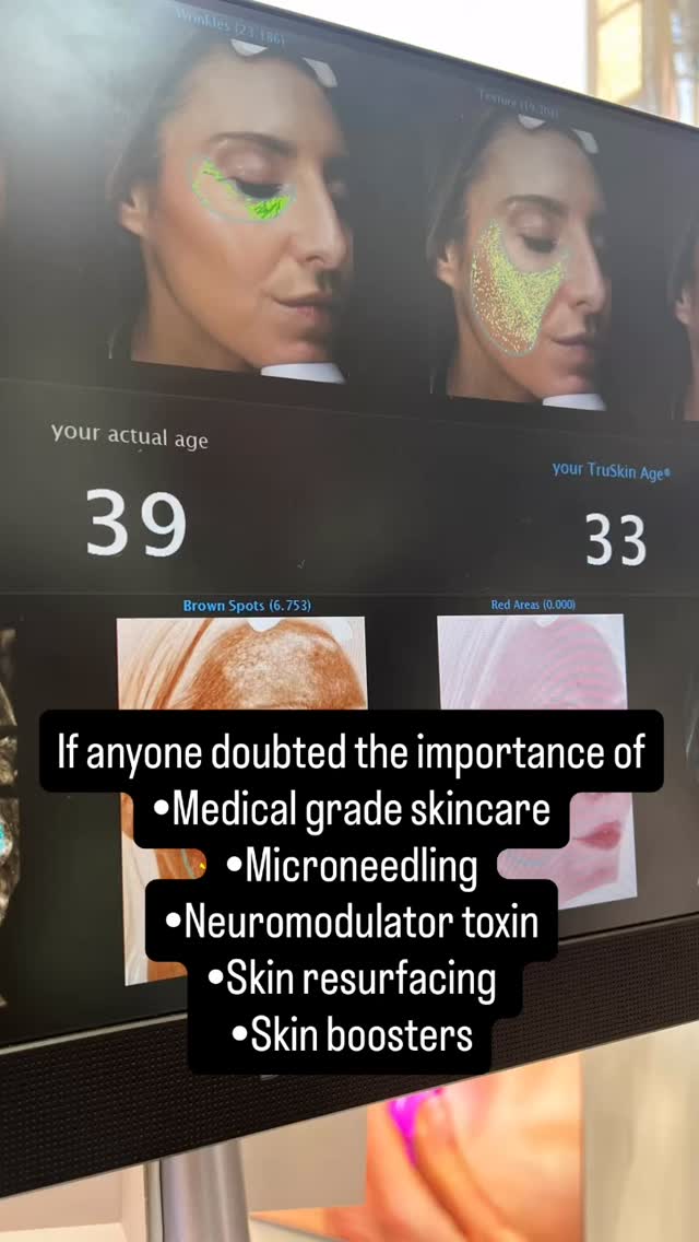If anyone ever doubted the importance of consistency with advanced skin treatments… here’s the proof.
Chronological age: 39
Skin age: 33
Results like this don’t happen by chance — they’re built with the right combination of:
• Medical-grade skincare
• Microneedling
• Neuromodulator toxin
• Skin resurfacing
• Skin boosters
Healthy, supported skin will always outperform quick fixes. Prevention, regeneration, and maintenance make all the difference.
Your skin is an investment — start early, stay consistent, and let the results speak for themselves.
#SkinAge #MedicalGradeSkincare #AestheticMedicine #SkinHealth #PreventativeAesthetics Microneedling SkinBoosters