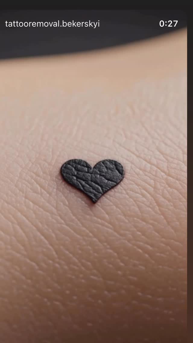 The laser breaks the pigment.
Your body removes it.
Session by session, the ink fades - and your skin gets a fresh start.