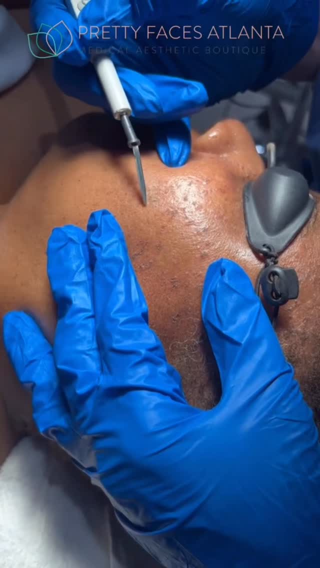 At PFA, it’s way easier than you think.
Skin tags? Quick snip and done.
Most moles? We use a hyfrecator to gently and precisely remove them with minimal discomfort and little to no downtime.
And right now… take advantage of 40% OFF full face mole removal ✨
Fast, safe, and confidence boosting instantly. No more overthinking.
This is your sign to finally get it done.
Book your appointment today and let’s clear your skin the easy way.
#MoleRemoval #SkinTagRemoval #AtlantaMedSpa #PrettyFacesAtlanta #ClearSkin