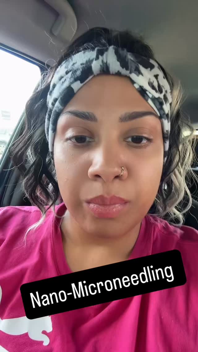 Nanomicroneedling! Ask Today! #skincare #jesuslovesyou #microneedlingtreatment