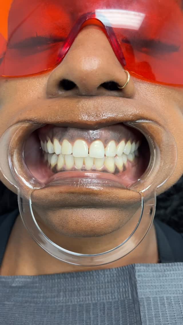 Because You Deserve A White Smile!
Book a Teeth Whitening session with @beatandblade!
“Enhancing Lives Ine Image At A Time”™️
BEATANDBLADE.COM
📍River Oaks Houston
#teethwhitening #whiteteeth #smile #dental #beforeandafter