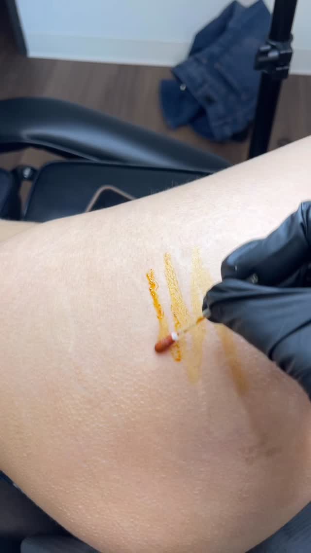 Stretch Mark Camouflage/Medical Tattooing by @beatandblade
This video is live footage of camouflaging stretch marks of the buttocks and hip region after four pregnancies.
This is a paramedical tattoo where gradual results develop over time as the skin heals and pigment settles. A custom ink formula was created based on chemistry and theory to mimic skin and conceal white/hypopigmented stretch marks. Each treatment session is spaced about three months apart to allow proper recovery and natural blending with no downtime.
Every case is different and requires proper training, technique, and pigment knowledge.
Check back for healed results!
#scarcamouflage #medicaltattoo #tattoo #tattooartist #houston