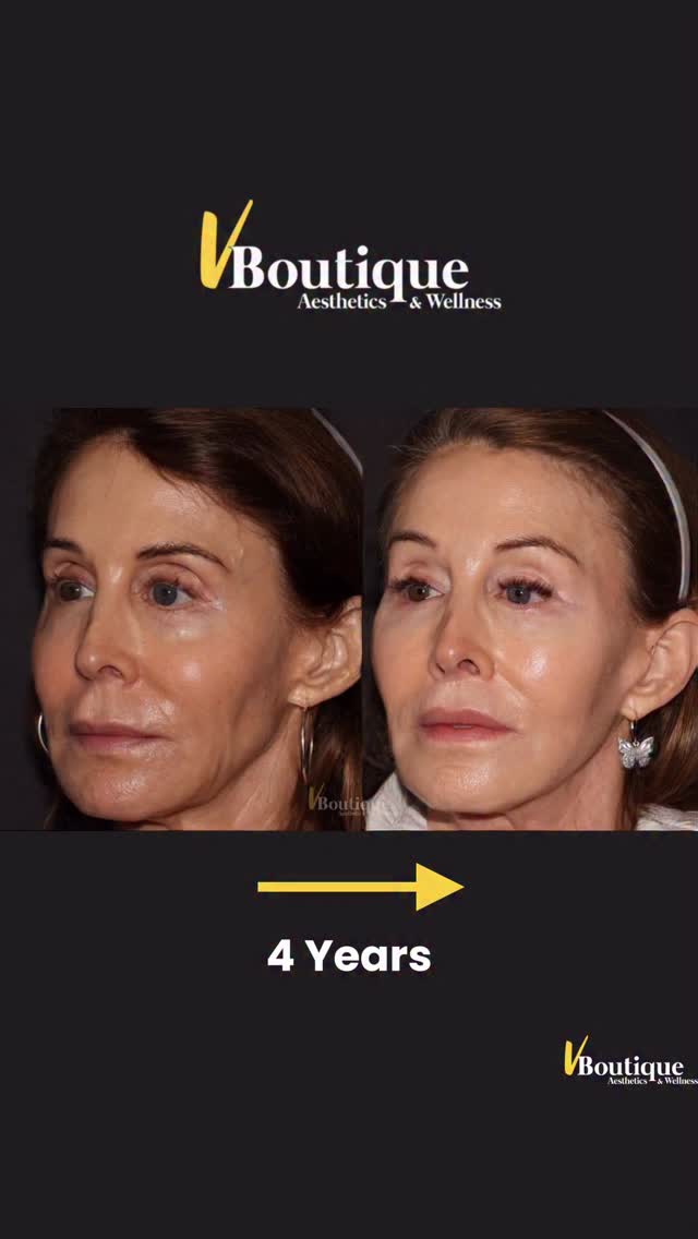 ✨ 4 years. Subtle changes. Beautiful results. ✨
This transformation is a perfect example of what happens when treatments focus on restoring structure rather than chasing trends👍🏻.
This patient has incredible bone structure, but over time she lost volume in the temples, pre-auricular area (in front of the ears), and jawline, creating hollowing, sagging along the jawline, and a tiered😪 appearance.
💉 Sculptra®️ injectable was used to restore that lost support- stimulating her own collagen production, gradually rebuilding structure and volume.
✨ The results:
• Natural volume restoration
• Repositioning of soft tissues
• A smoother, more youthful jawline
💉 Dysport injections in the upper face, lower face to soften wrinkles and reduce downward pull of muscles for a subtle lifting effect.
✨ IPL (Intense Pulsed Light) treatments to stimulate collagen, improve tone, and give the skin a healthy glow.
And of course—great skincare and consistent sun protection. ☀️🧴
The goal is never to change someone’s face.
It’s to restore what time has quietly taken away—so they still look like themselves, just refreshed.
#Sculptra
#CollagenStimulation
#NaturalRejuvenation
#AestheticMedicine
#facialbalancing
