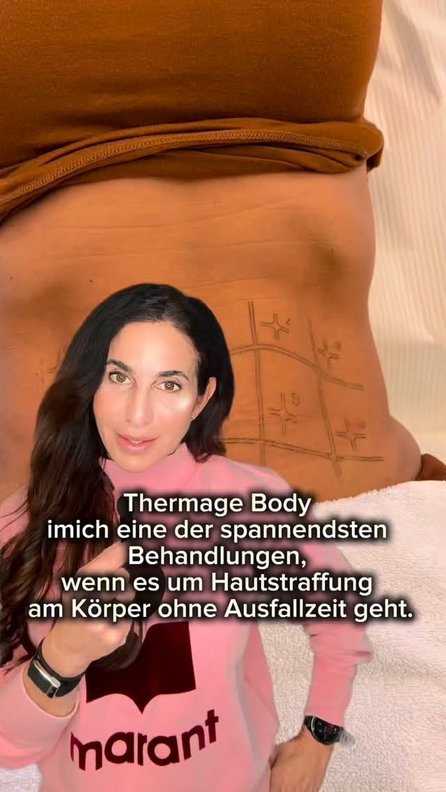 Mit @thermageskintightening Body können wir die Hautqualität und Straffheit am Körper gezielt verbessern — ganz ohne OP und mit in der Regel kaum Ausfallzeit.
Was ist Thermage Body?
Thermage ist ein radiofrequenzbasiertes Verfahren, bei dem kontrollierte Wärme in tiefere Hautschichten eingebracht wird.
Dort wird die Kollagenneubildung angeregt und bestehende Kollagenstrukturen werden stimuliert.
Das Ziel: mehr Festigkeit, mehr Spannung, ein glatteres Hautbild.
Für welche Areale eignet sich die Behandlung?
Besonders häufig behandle ich:
Bauch, Oberarme, Oberschenkel, Kniebereich, Flanken und je nach Befund auch andere Körperregionen mit nachlassender Hautspannung.
Wie wirkt es?
Die Wärme wirkt in der Tiefe, ohne die Hautoberfläche wesentlich zu verletzen. Dadurch ist Thermage vor allem dann spannend, wenn es um leichte bis moderate Hauterschlaffung, eine Verbesserung der Hauttextur und ein insgesamt strafferes Erscheinungsbild geht.
Wann sieht man Effekte?
Ein Teil der Patientinnen bemerkt schon relativ früh ein festeres Hautgefühl. Der eigentliche Effekt entwickelt sich dann schrittweise über die folgenden Wochen und Monate, wenn die Kollagenremodellierung einsetzt.
Das bedeutet: kein unnatürliches Sofortergebnis, sondern ein Prozess, der mit der Zeit sichtbar wird.
Wichtig zu wissen:
Thermage Body ist keine Methode zur Gewichtsreduktion, sondern ein Verfahren zur Hautstraffung und Verbesserung der Hautqualität. Besonders schön kann es auch als Teil eines individuellen Kombinationskonzepts sein.
Call to Action:
Du möchtest wissen, ob Thermage Body für dein Areal sinnvoll ist?
Schreib mir gerne eine Nachricht oder buche dir einen Beratungstermin in meiner Praxis.
#thermage #thermagebody #hautstraffung #bodycontouring #aestheticmedicine