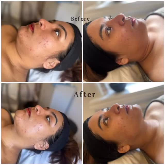HIFU Results ✨
Non-surgical lifting with real results.
HIFU works deep within the skin to stimulate collagen and tighten tissue, giving a natural lifted appearance over time.
Results improve over the next few weeks as collagen rebuilds.
📩 DM for consultation.
#BeforeAfter #HIFUResults #FacialLifting #SkinRejuvenation
