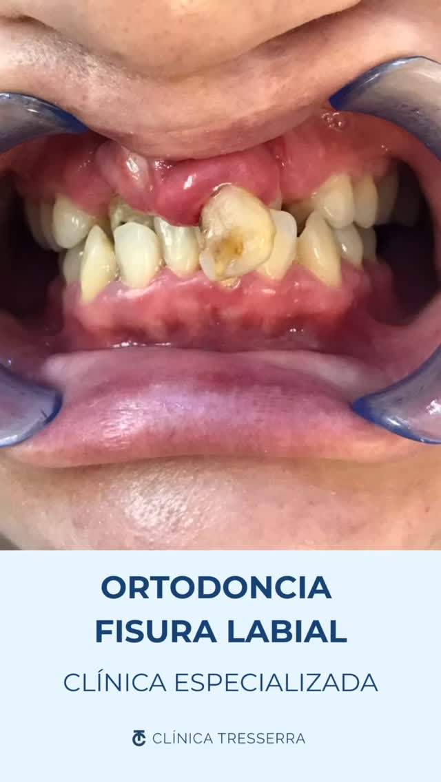 ✨ Antes y después que hablan por sí solos.
Este caso de ortodoncia muestra la importancia de un equipo especializado multidisciplinario, con una correcta planificación y un seguimiento personalizado pueden transformar no solo la sonrisa, sino también la función y la confianza.
🦷 Alineación
✔️ Mejora funcional
✔️ Estética natural
✔️ Resultados estables
Porque cada sonrisa tiene su propio proceso…
y cada resultado, una historia detrás.
💬 ¿Te imaginas un cambio así en tu sonrisa?
📩 Guarda o comparte este antes y después con quien esté pensando en ortodoncia.
#fisuralabiopalatina #ortodoncia #ClínicaTresserra #ortodonciafisurado #fisuralabial