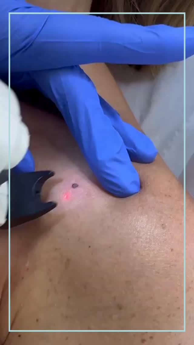 |DERMATOLOGIA|
Els angiomes, coneguts també com a angioma robí o angioma en cirera, són una alteració benigna dels vasos sanguinis superficials.
El tractament es realitza amb làser i en una sola sessió aquests desapareixen.
És un tractament que no requereix anestesia i és pràcticament indolor.
#dermatologia #dermatologianadorra #angioma #vascular #puntrobi #dermandtek #dermandtekandorra