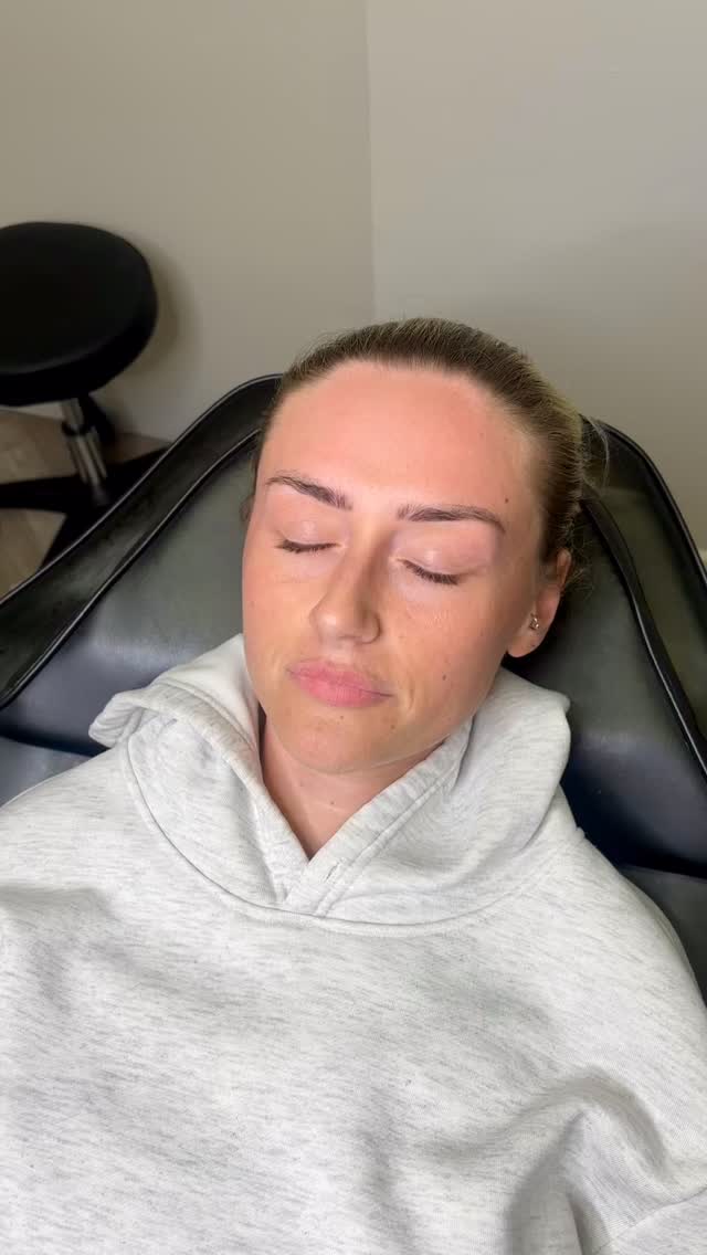 0.5ml lip enhancement 🤍
The goal: Soft volume, defined cupid’s bow, plump with a natural finish.
She didn’t want the ‘Russian style’ technique — just balanced, subtle perfection.
Less filler, better placement ✨
𝐂𝐞𝐓𝐞 𝐀𝐞𝐬𝐭𝐡𝐞𝐭𝐢𝐜𝐬
👩🏽⚕️ 𝐑𝐞𝐠𝐢𝐬𝐭𝐞𝐫𝐞𝐝 𝐧𝐮𝐫𝐬𝐞
📧 𝐜𝐡𝐥𝐨𝐞@𝐜𝐞𝐭𝐞𝐚𝐞𝐬𝐭𝐡𝐞𝐭𝐢𝐜𝐬.𝐜𝐨.𝐮𝐤
📲 𝐰𝐰𝐰.𝐜𝐞𝐭𝐞𝐚𝐞𝐬𝐭𝐡𝐞𝐭𝐢𝐜𝐬.𝐜𝐨.𝐮𝐤
📍 𝟐𝟕𝟖 𝐀𝐬𝐡𝐛𝐲 𝐇𝐢𝐠𝐡 𝐒𝐭𝐫𝐞𝐞𝐭, 𝐃𝐍𝟏𝟔 𝟐𝐑𝐗, 𝐒𝐜𝐮𝐧𝐭𝐡𝐨𝐫𝐩𝐞
For an appointment: Please send a DM or you can book directly via the link below ⬇️
www.ceteaesthetics.co.uk
-
#scunthorpeaesthetics #dermalfiller #lincolnshireaesthetics #nurse #ceteaesthetics