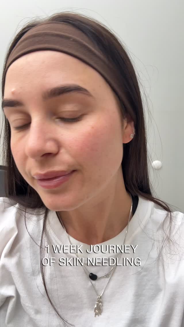 Watch this before you expect overnight skin results…
This is 1 week of microneedling captured properly!
Not just the glow, but the process.
Before: real skin, texture, life.
Immediately after: flushed, activated, working beneath the surface.
24 hours: calming, regenerating, rebuilding.
1 week: smoother, refined, quietly radiant.
And this is from just one treatment, with more intentionally layered into my treatment plan.
Understanding that true results come from consistency, not quick fixes.
If you’re investing in your skin this season, start with a consultation via the link in our bio 🤎