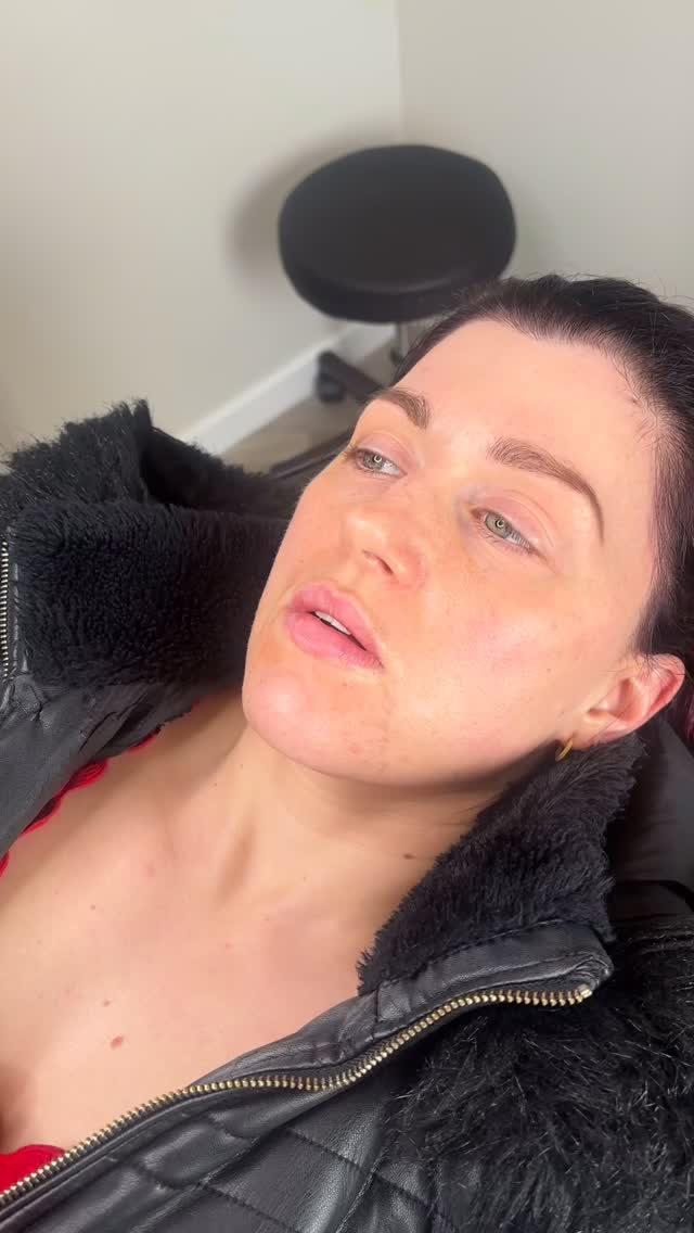 Premium 1ml Lip Enhancement using Teosyal RHA Kiss 💋
The premium ranges we offer are developed with more advanced formulations.
This means:
• A softer, more natural feel
• Product that moves with your facial expressions
• Smoother, more refined finish
• Longer-lasting results in many cases
If you’re unsure which option is right for you, we’ll guide you during consultation to ensure the best outcome for your lips.
——
#scunthorpeaesthetics #dermalfiller #lincolnshireaesthetics #lipfillers #nurse