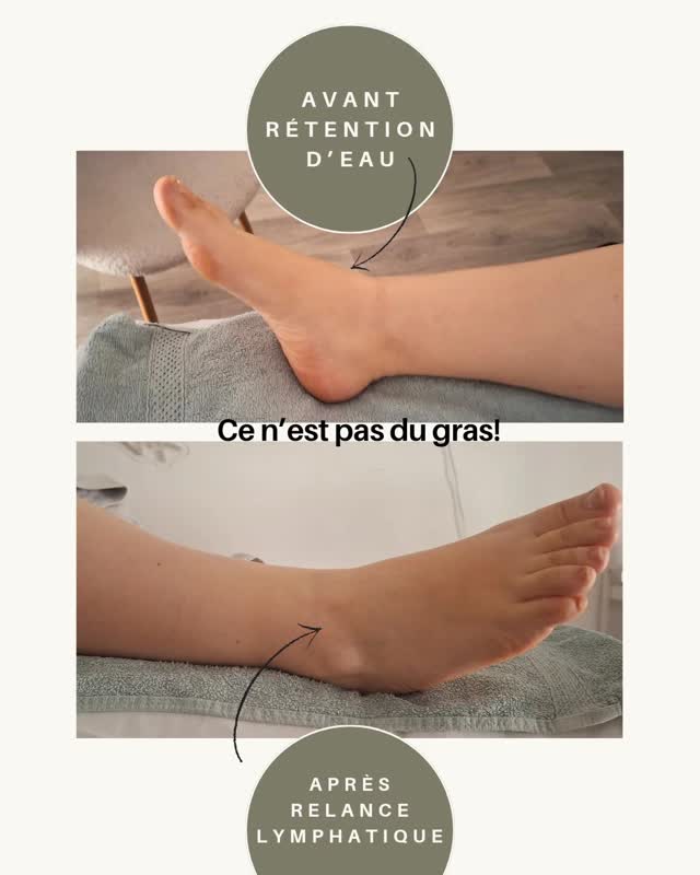 Beaucoup de femmes pensent avoir “du volume”…
alors qu’il s’agit parfois simplement d’eau qui stagne.
Ici, on voit un pied chargé, avec une circulation ralentie.
Après relance lymphatique, les tissus se décongestionnent.
Le corps s’allège.
Les contours réapparaissent.
Et surtout…
on comprend enfin ce qui se passe dans son corps.
🌿 Le drainage, ce n’est pas qu’esthétique
c’est aussi fonctionnel
👉 Si tu te reconnais, écris-moi “DRAINAGE” en message privé