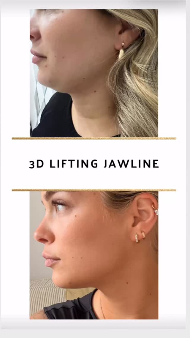 Hier möchte ich Euch einfach nur eine Bewertung der Kunden, Nadine mitteilen😍
Ich war vor fast 3 Monaten bei der Lieben Joanna und habe bei ihr ein 3D Lifting an der Jawline und am Doppelkinn bekommen.
Ich habe mich sehr wohl und bestens aufgehoben gefühlt bei ihr &
Joanna ist nicht nur super professionell, sondern auch total herzlich und nimmt sich viel Zeit für eine individuelle Beratung.
Da ich schon sehr lange unter mein Doppelkinn und einer nicht ausgeprägten Jawline litt hat das Ergebnis meine Erwartungen wirklich übertroffen.
Meine Gesichtskontur wirkt nun deutlich definierter, frischer und gleichzeitig ganz natürlich.
Einfach genauso so, wie ich es mir gewünscht habe E
Besonders beeindruckt hat mich, wie sanft die Behandlung war und wie schnell man schon erste Ergebnisse sehen konnte.
Man merkt sofort, dass Joanna ihre Arbeit mit viel Leidenschaft und Präzision macht. Ich kann sie wirklich von Herzen weiterempfehlen und würde jederzeit wieder zu ihr gehen!🩷
die Kundin ist glücklich und ich bin überglücklich 😍🥰❤️
#hautstraffung #jawline #facelifting GESICHTSKONTUR, Doppelkinn Entfernung