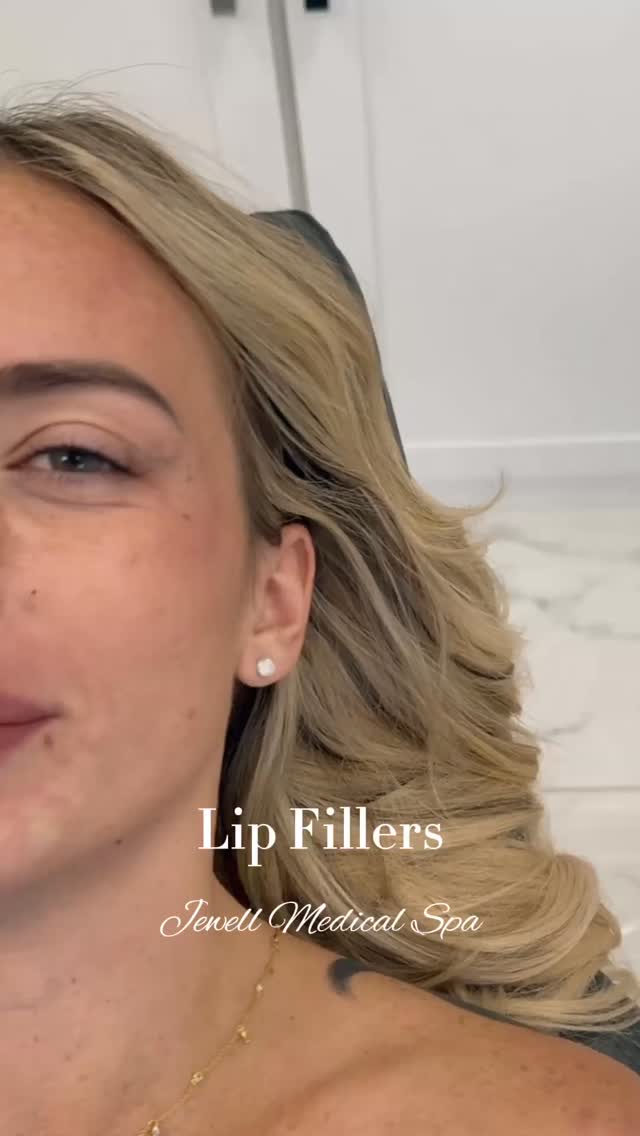Fuller lips, bigger confidence. 💖
Whether you want a soft boost or a more defined look, lip fillers are the ultimate way to elevate your smile. 💄
Call or text today to book your appointment!
☎️ 239-448-3383
📩 chris.jewell@jewellmedicalspa.com
🌐 www.jewellmedicalspa.com | www.mrinjectable.com
📍 1044 Castello Drive, Ste 213 Naples Florida 34103
💳 We Accept Care Credit!
*
*
*
#lipfiller #lipfillers #lipaugmentation #lipplump #lipinjection #lipenhancement
#lipcontouring #restylanelips #injectables #dermalfillers #cosmeticinjectables #aesthetics #beauty #restylane #restylaneusa #naplesbeauty #naplesinjector #medspa #dolllips #lippies #bestaestheticinjectors #beforeandafter