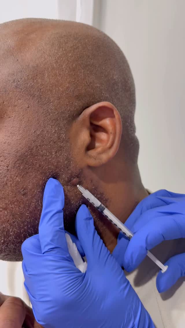 Stubborn skin tags or moles? 👀
You don’t have to live with them anymore
Quick, precise removal with little to no downtime… just smoother, clearer skin 🔥
Save 40% OFF full face removal for a limited time
Book now and let’s see what plan works best for you 💉✨
#MoleRemoval #SkinTagRemoval #ClearSkin #GlowUp #PFAAtlanta