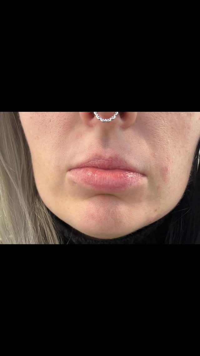 Dreaming of fuller lips? 👄 It's totally achievable and easier than you might think! Lip filler can give you that boost you're looking for. We can help you explore your options and find the perfect look. Imagine those perfect pouty lips you've always wanted! ✨ Let's chat about making it happen. #LipFiller #FullerLips #BeautyGoals #AestheticClinic #bristolaesthetics