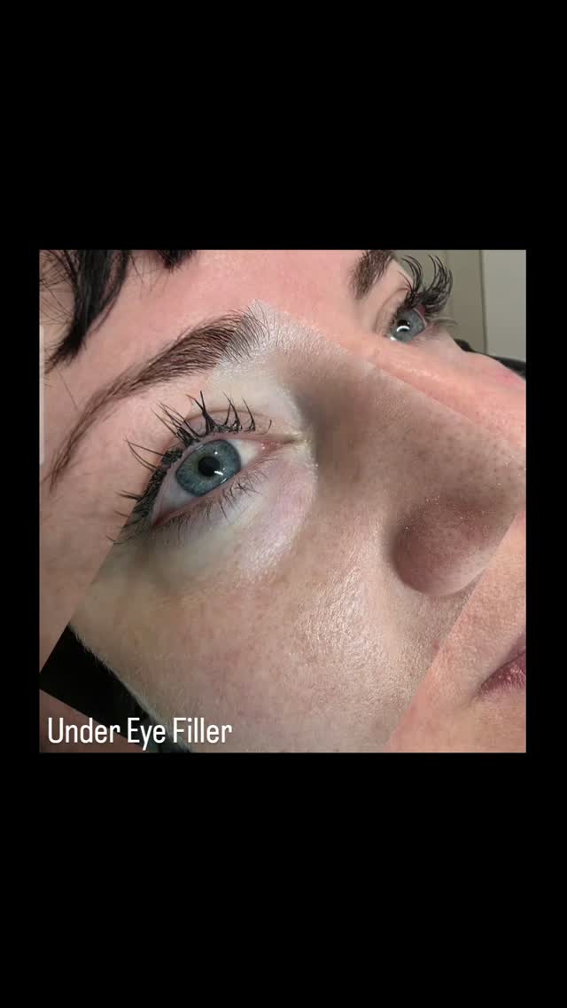 Under eye filler? Its a great choice to help demise Thinking about under eye filler? 🤔 It's a fantastic option to help diminish under-eye shadows! ✨ It can really give you a smoother, more refreshed look. I love how it can instantly brighten the whole face. Definitely worth considering if you're looking for a subtle yet impactful change! 💉 #undereyefiller #beautyhacks #skincaregoals shadows giving much smoother skin.
