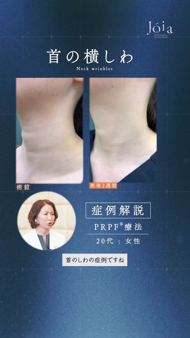 .
.
PRPF®療法の症例について解説します。
今回は「首のしわ」にお悩みの患者様の症例です。
幅広く深いしわの方と、細い線状のしわの方
どちらのしわにも対応可能なのがPRPF®︎療法です。
首のしわに注入する際は二層に分けて繊細に注入します。
院長が解説しておりますので、是非こちらの動画をご視聴ください。
PRPF®療法は、患者様ごとに状態が異なるため
適切な層・量・デザインの見極めが重要となります。
同様のお悩みをお持ちの方の参考になれば幸いです。
詳しくは診察にてご相談ください。
【施術内容】
PRPFをJUVA penで深層と浅層と二層に分けて精密に注入。
【年代】
30代:女性
【施術費用】
PRPF2.2cc
¥220,000(税込)
【ダウンタイム】
約1週間
【副反応・リスク】
発赤、皮下出血斑、腫れ(約1週間程度)
【施術内容】
PRPFをJUVA penで深層と浅層と
二層に分けて精密に注入。
【年代】
20代:女性
【施術費用】
PRPF3.3cc
¥330,000(税込)
【ダウンタイム】
約1週間
【副反応・リスク】
発赤、皮下出血斑、腫れ(約1週間程度)
Jóia Clinic Kyoto
TEL:075-229-6388
診療時間 10:00~18:00
休診日 日・月・祝
#ジョイアクリニック#PRPF#首のシワ#症例解説