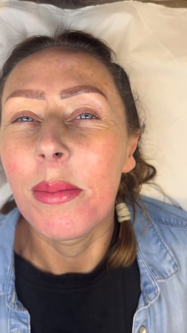 The most gorgeous lip blush for the most beautiful client!
Swelling will go down and colour will fade by 40%
@killerbeautypmu @tinadaviesprofessional - Bazooka and peach 50/50 split
@kwadron_pmu - 0.25 3RL & 1RL
#spmu #lipblush #lipblushtattoo #spmulips #spmuartist