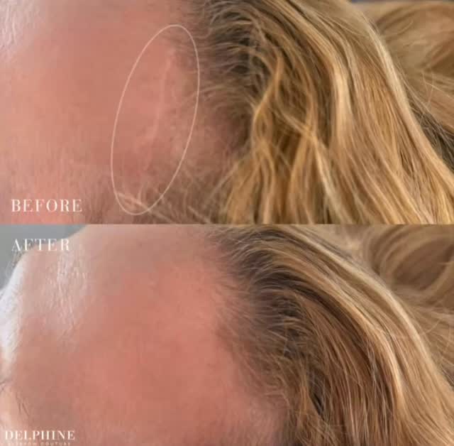 Scar restoration through micropigmentation ✨
This journey takes time — typically 3–4 treatments to achieve the desired, natural-looking result. Each session builds on the last, allowing your skin to heal and respond beautifully.
Healing is part of the process, and results don’t happen overnight.
Patience and understanding are the keys 🔑
#ScarRestoration #Micropigmentation #SkinHealing #ParamedicalTattoo #ConfidenceRestored BeforeAndAfter HealingJourney SkinCare BeautyBeyondScars