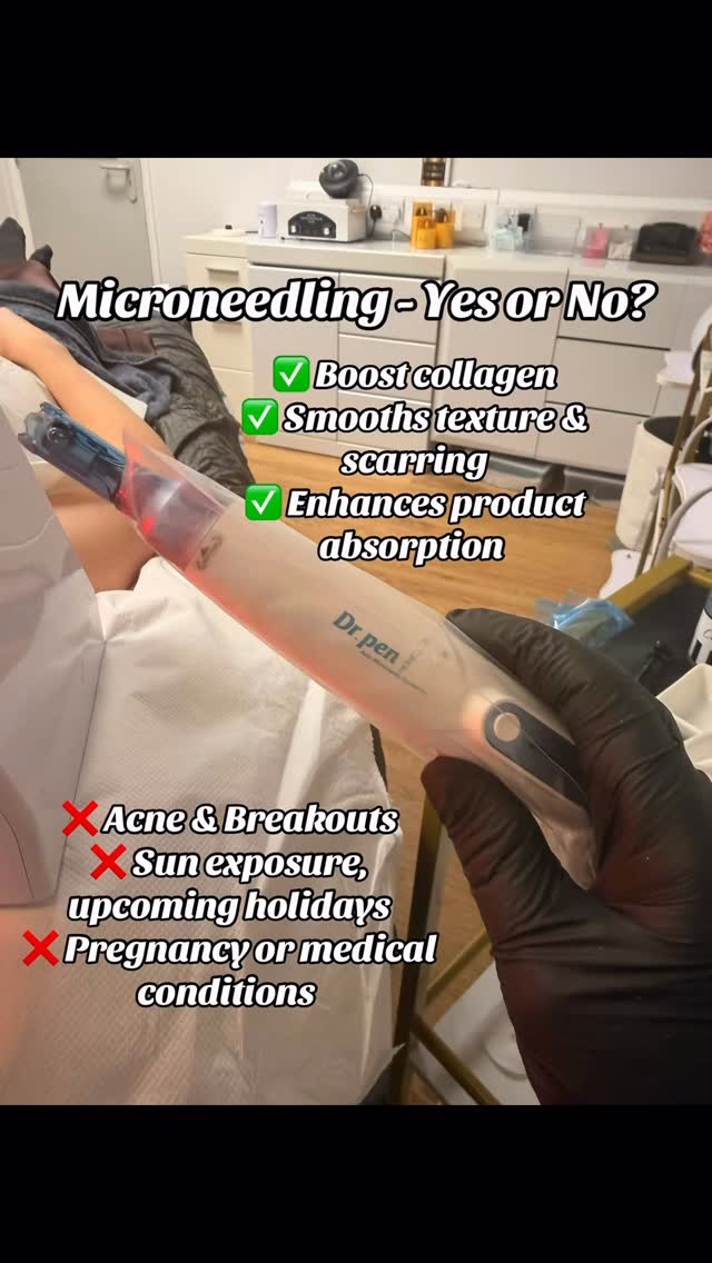 Thinking about microneedling but not sure if it’s right for you?
Here are 3 reasons it might be a YES… and 3 reasons it might be a NOT RIGHT NOW.
✨ 3 Reasons It Might Be a YES
✅ You want smoother, more refined skin texture — microneedling boosts collagen to soften fine lines and unevenness.
✅ You’re looking to improve scarring or pigmentation — it can help break down old scar tissue and even out tone.
✅ You want a natural glow boost — it stimulates fresh, healthy skin from within and supports product absorption.
⏳ 3 Reasons It Might Be a NOT RIGHT NOW
❌ Your skin is currently inflamed or compromised — active acne, eczema, or irritation need to settle first.
❌ You’re pregnant, breastfeeding, or on certain medications — timing matters for safety and best results.
❌ You can’t commit to the aftercare — avoiding makeup, heat, and sweating for a short period is essential.
Microneedling can be transformative, but the right timing and skin condition make all the difference. If you’re unsure which side you fall on, just drop me a message.
#facial #antiaging #fyp #skincare #cambridge