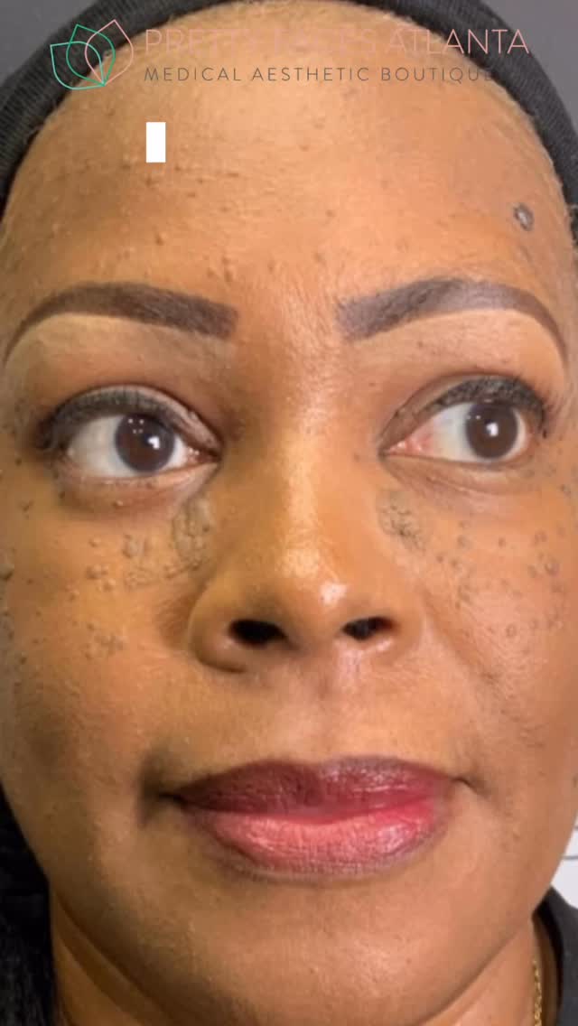 Full face mole removal just got a MAJOR upgrade ✨
Save 40% OFF and completely transform your look in one session. Clearer skin, smoother texture, and a confidence boost you can’t ignore.
At PFA, most moles are safely removed using advanced techniques like the hyfrecator, making the process quick, precise, and minimal downtime 🙌🏽
Stop covering it up… fix it ✔️
Book now before this sale is gone.
#MoleRemoval #AtlantaMedSpa #ClearSkinJourney #SkinTransformation #PrettyFacesAtlanta