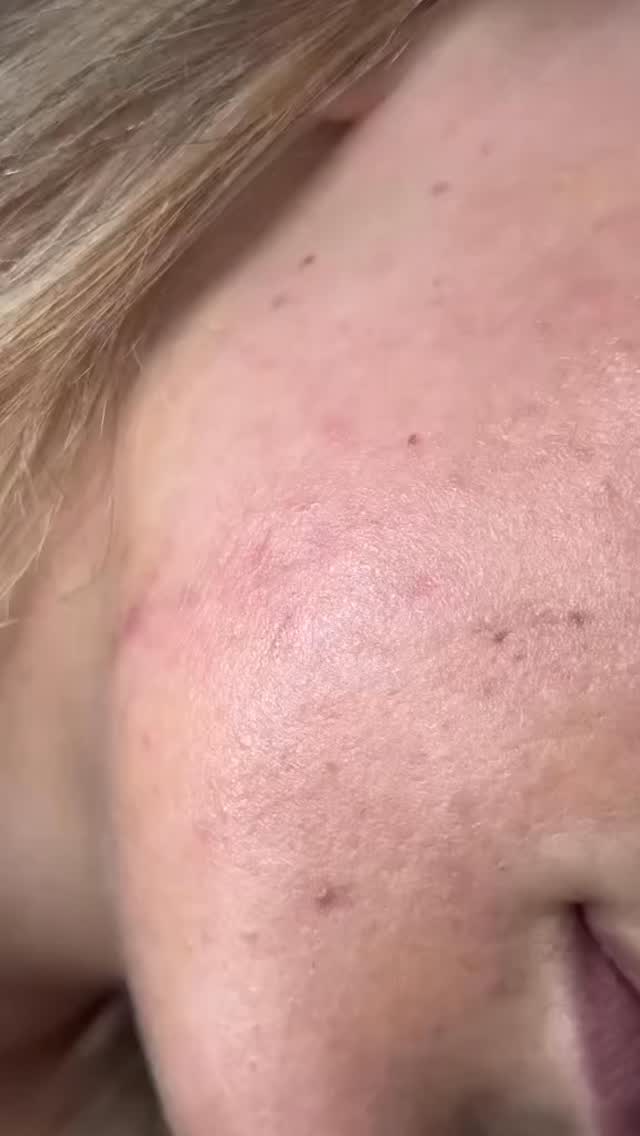 Esthetician @brittsbeauty123 shares how the Bioelements VC10 duo elevated her skin care routine 👆
VC10 Daily Glow and VC10 Nightly Bright work together to help support brighter looking skin, improve the appearance of uneven tone, and boost overall radiance. Powered by a stabilised vitamin C complex they are designed to support luminosity while maintaining skin hydration and barrier balance.
A great professional recommendation for clients looking to support brighter more radiant looking skin in their daily routine.
Stockist inquiries
www.salonconnect.com.au
#BioelementsAU #SalonConnectAU #ProfessionalOnlySkincare #ClinicalSkincare #VitaminCSkincare