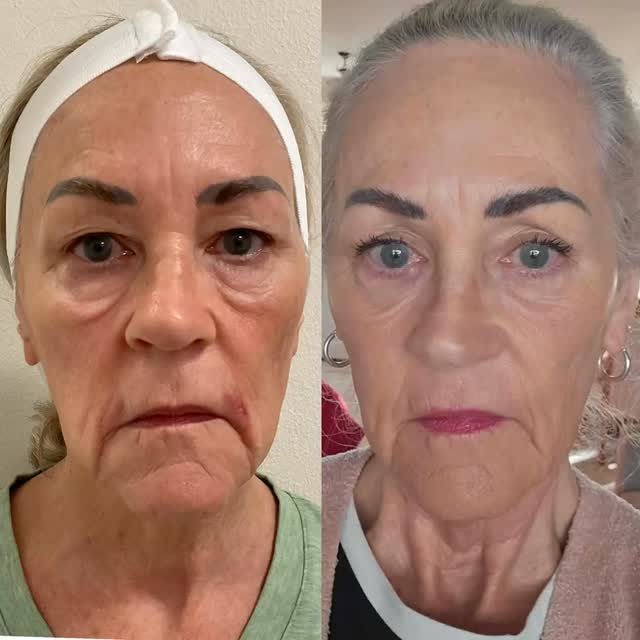 Not overnight. Not instant. But in just 3 months, patience and commitment .Stay consistent-results will come.
#sarasotaflorida #hifu #sarasota #capricebeautybar #hifu
Book you Hifu/ thermage treatment today @
Capricebeautybar.com