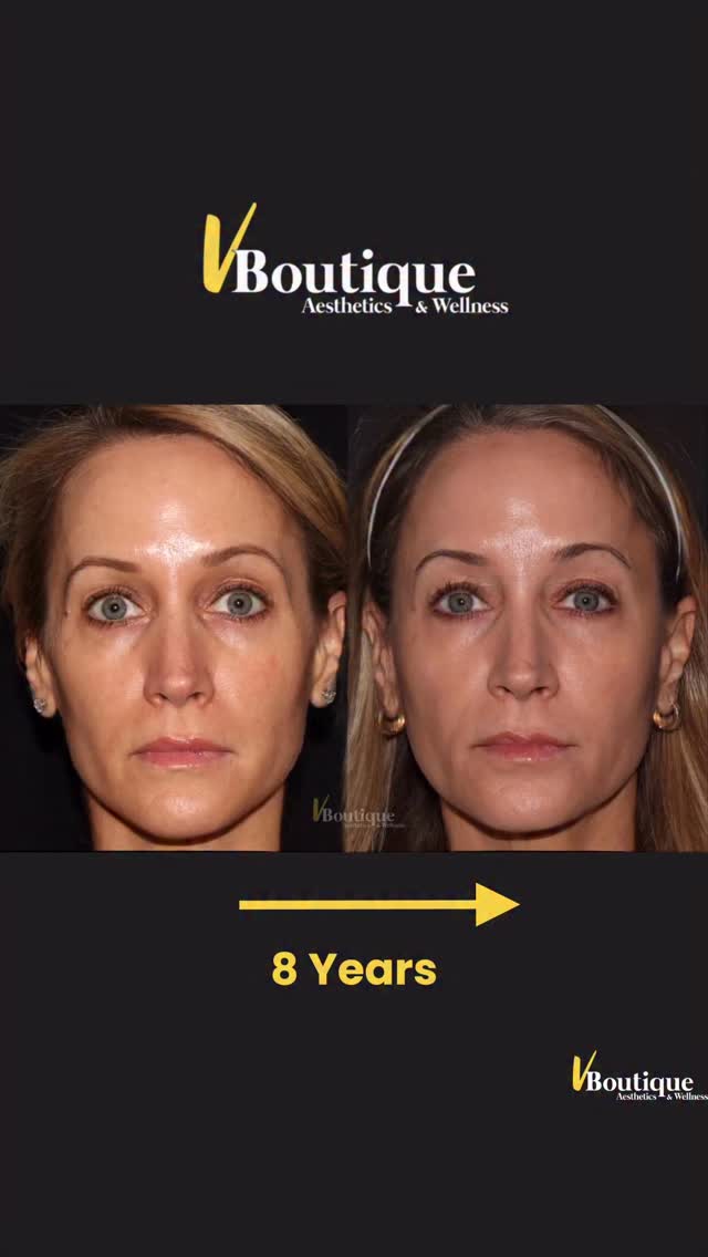 ✨ 8 years. Same beautiful woman. Just better. ✨
Aging doesn’t have to be a sudden drop — it can be a slow, graceful curve that you gently guide over time.
This is what consistency + intelligent design looks 👍🏻 .
Over the past 8 years, we’ve focused on small, strategic interventions:
💉 Dysport to relax muscles, soften lines, and create a subtle lift
✨ IPL + Clear & Brilliant gentle lasers to refine pores, boost glow, and stimulate collagen
🌿 Sculptra to restore volume gradually and build your own collagen (“the natural Spanx effect”)
No extremes. No overfilling.
Just supporting the skin’s biology — collagen, elastin, structure — year after year.
The result?
She doesn’t look “done.”
She looks like herself… just rested, refreshed, and beautifully preserved.
This is how we slow aging, and even reverse its visible signs — not with one treatment, but with a thoughtful sequence over time.
✨ I thank my beautiful patient for allowing us to share her journey🙏🏽.
#NaturalAesthetics #SculptraResults #HealthySkinAging #SubtleEnhancement #AestheticMedicine