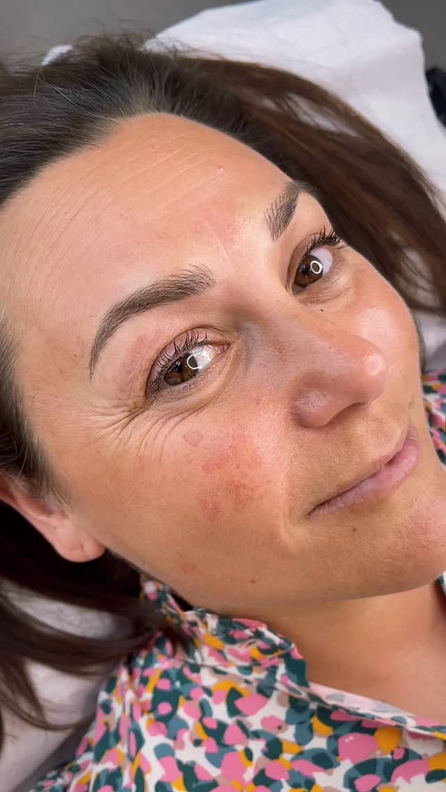 Obsessed with this results…. 😍
Correcting symmetry with this soft combi brow 🙌
.
.
.
.
.
#LuxuryBrows
#LuxuryBrowsUK
#HighEndBeautyUK
#BespokeBrows
#PrecisionBrows
