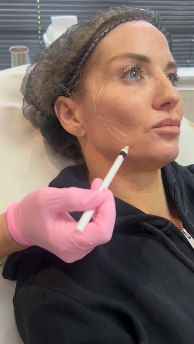 PLLA is where real collagen transformation begins… not instant, but undeniable 🔬✨
If you’re ready to move beyond basic injectables and step into true regenerative aesthetics, this is your next level.
Our PLLA training teaches you how to stimulate the skin from within — restoring structure, improving laxity, and delivering results your clients will see evolve over time.
This isn’t just another treatment.
It’s how you build high-value, long-term patient journeys and stand out in a saturated market.
Inside the training, you’ll learn:
– Advanced patient assessment & consultation
– Precise dilution + reconstitution techniques
– Safe, strategic injection protocols
– Managing expectations & results timelines
– How to position PLLA as a premium treatment
This is for practitioners who want more than quick fixes.
This is for those building authority, results, and retention.
Elevate your practice now.
DM “PLLA” to secure your place.
#AestheticTrainingUK #PLLA #AdvancedAesthetics #InjectablesTraining #SkinRejuvenation
