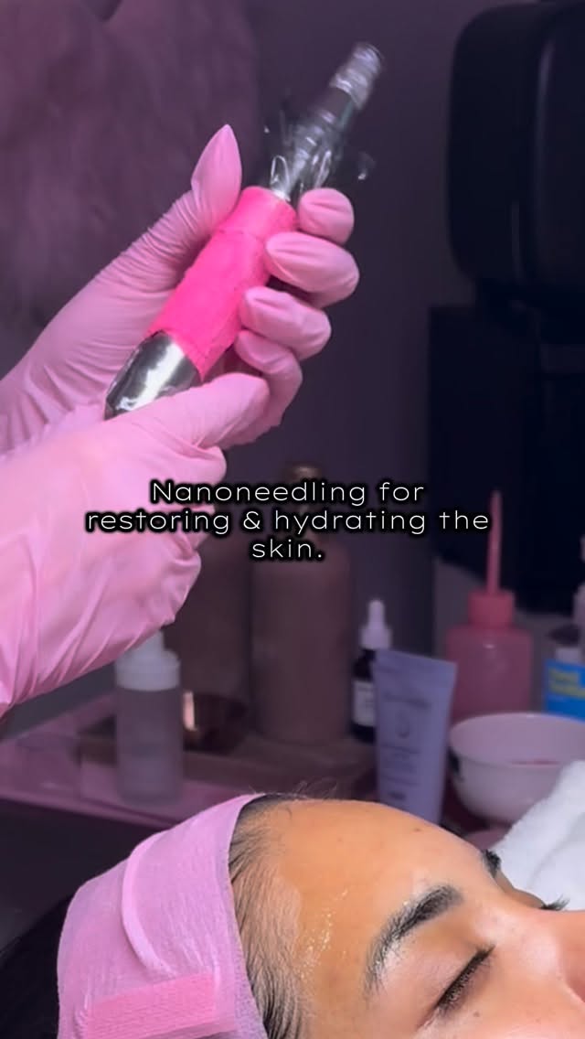 Try nanoneedling to bring dry dull skin back to life 💓
My favorite tool for restoring hydration + healing post acne marks.
What to expect:
• Immediate Glow from increased hydration and product absorption.
•Minimal downtime, if you’re nervous about microneedling, try nanoneedling. Creates microchannels on the top layer of the skin.
#arizonacnespecialist#azfacial#phoenixskincare#barrierrepairaz#nanoneedlingaz