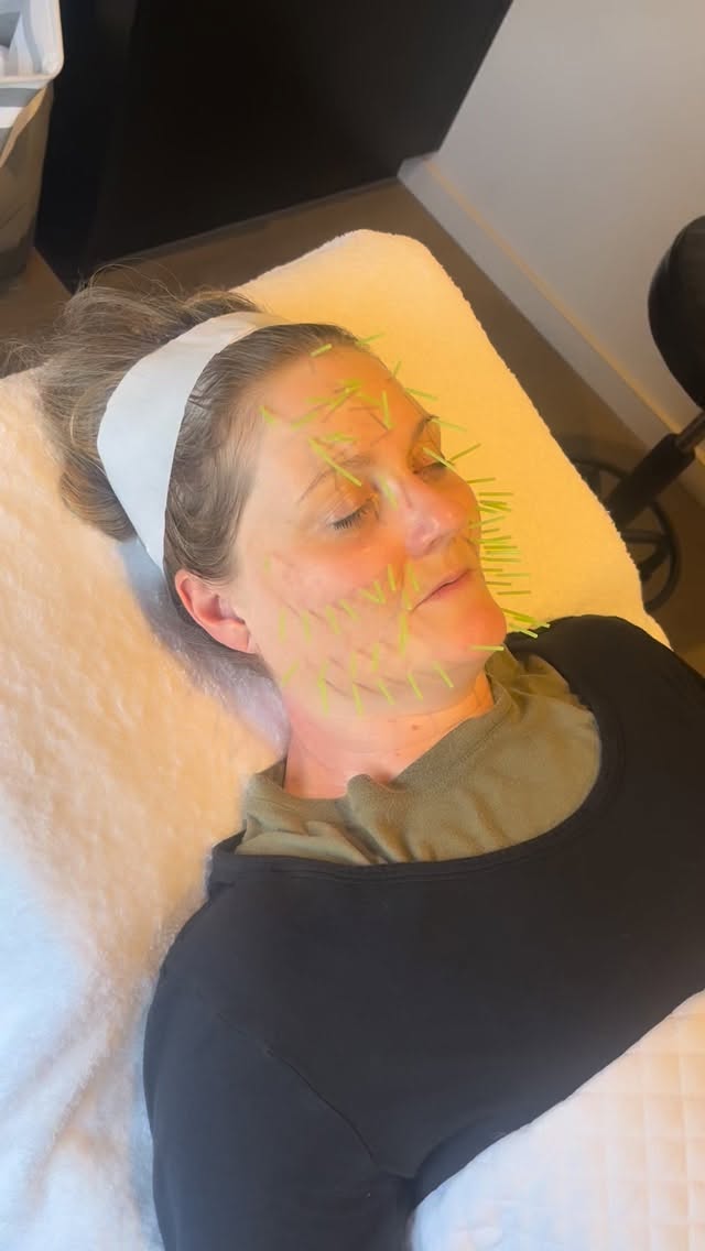 Every Cosmetic Acupuncture Facial goes beyond just the skin✨
Each treatment includes body acupuncture to support and correct internal imbalances while enhancing your natural glow.
As we work on lifting and toning facial muscles, stimulating collagen, improving pigmentation, and promoting healthy circulation to help clear acne, we are also supporting your whole body wellbeing by balancing hormones, boosting digestion, encouraging detoxification, enhancing lymphatic flow, and calming your nervous system.
Because reaching your skin goals always starts from within 🤍
Use code WELLNESS26 to get 15% off your first acupuncture treatment 👀🫶
#acupuncture #facialacupuncture #holisticskincare #skinhealth #wellness