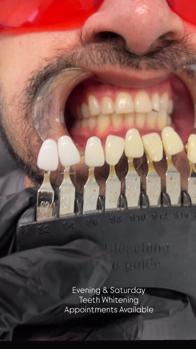 Book a Teeth Whitening appointment with @beatandblade for a whiter and brighter smile!
BEATANDBLADE.COM
#teethwhitening #whiteteeth #smile #veneers #selfcare