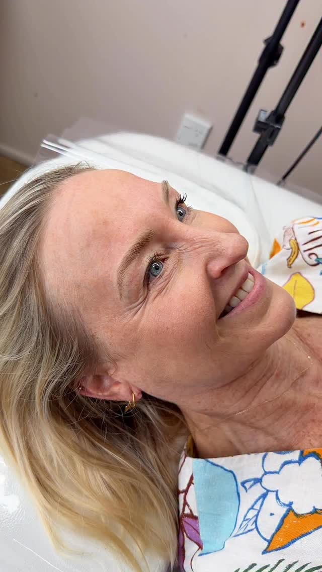 💁♀️My beautiful Client drove down from Napier to get her Hairstroke Brows done, and Drive back on the same day❤️❤️❤️🥹🙏
She had been researching for long time and keep coming to our website! She called yesterday and got brows done to day 💪!
#hairstrokebrows #browmasterartist #judynguyennz #cosmetictattoo #semipermanentmakeup