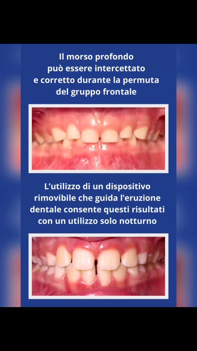 Corso di Ortodonzia precoce
Verona 17 e 18 aprile 2026
Dr. Gioacchino Pellegrino
#ortodonzia #ortodonziafunzionale #miofunzionale