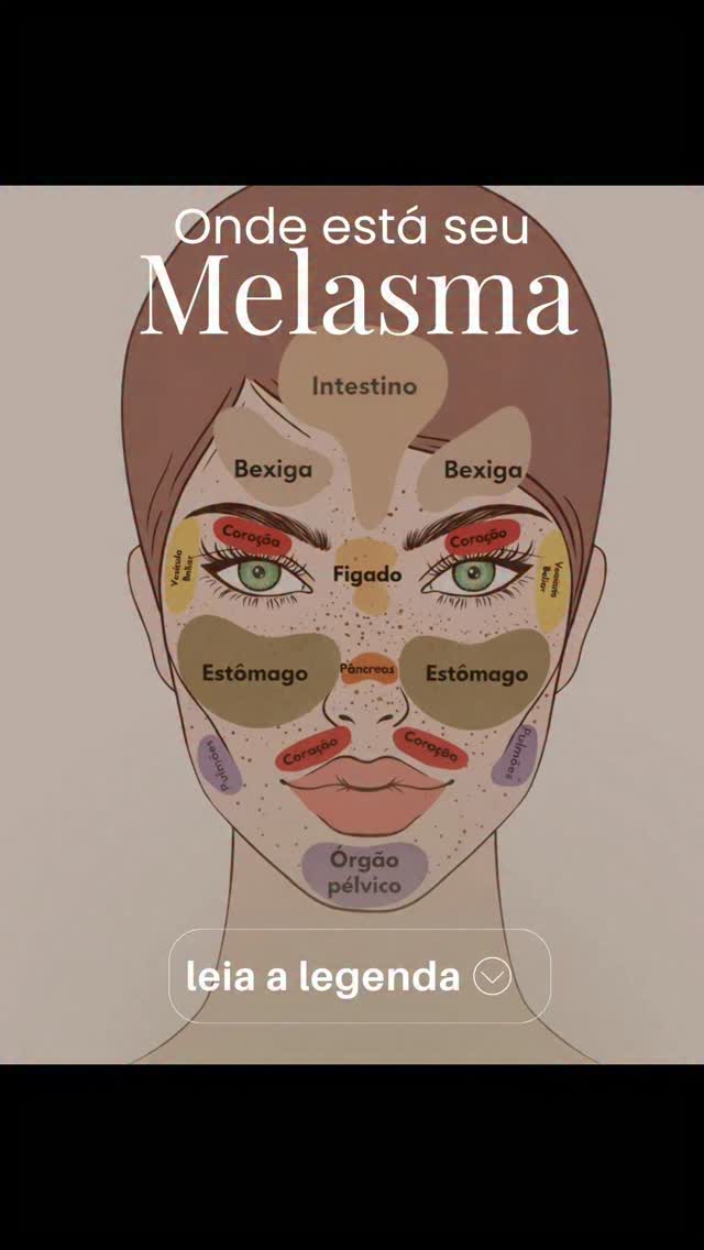 Por que seu creme caro não funciona (e o que a Nutrodermatologia faz por você) 🧴🩺
Você gasta fortunas em séruns de última geração, segue a rotina de skincare à risca, usa filtro solar certinho mas a mancha de melasma insiste em voltar, a pele continua opaca e sem firmeza após os 40. Frustrante, não é?
A imagem que você vê ao lado (o "mapeamento facial") traz um conceito antigo, mas que esconde uma verdade médica irrefutável: a pele é o reflexo do seu equilíbrio interno.
❌ O erro comum: Tentar tratar o melasma apenas "apagando" a mancha por fora. Isso é como colocar um curativo em uma ferida que precisa de pontos. O melasma não é a causa, ele é o sintoma de um desequilíbrio metabólico.
✅ A Abordagem Integrativa (Nutrodermatologia): No consultório, como médica dermatologista e nutróloga, meu foco é olhar para seu metabolismo. Não prescrevo apenas o creme; eu solicito exames e avalio parâmetros que a dermatologia tradicional muitas vezes ignora:
1️⃣ Sua Fisiologia Hormonal: Estrogênio, progesterona e tireoide regulados são a base da firmeza e do clareamento.
2️⃣ Seu Perfil Inflamatório: Insulina, PCR e homocisteína altos "ativam" o melanócito e pioram a mancha.
3️⃣ Suas Reservas de Nutrientes: Ferritina, Vitamina D, Zinco e Selênio são os "tijolos" que sua pele precisa para se renovar.
4️⃣ Sua Saúde Intestinal: Um intestino inflamado libera toxinas que se refletem diretamente na pele causando mais manchas.
🧬 Dominar o assunto é o segredo. O básico bem feito (Protetor + Creme) só funciona se o seu metabolismo esta funcionando corretamente!
PRONTA(O) PARA TRATAR A SUA PELE DE VERDADE?
Se você cansou de fórmulas mágicas e quer uma estratégia médica, integrativa e baseada em exames para recuperar o viço, a firmeza e clarear o melasma de forma sustentável, o momento é agora.
Digite SIM e vamos conversar!
#Melasma #nutrodermatologia
#autostimafeminina #drarenatavongal #clinicavongal