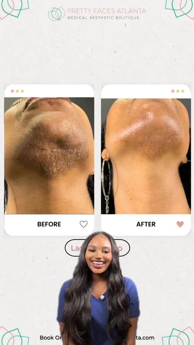 CONSISTENCY = RESULTS 🔥✨
Laser isn’t one and done… it’s a process.
Stay consistent and watch your skin transform 👇🏽
✨ Acne
✨ Dark spots
✨ Redness
✨ Texture
Packages:
💎 1 for $500
💎 2 for $550
💎 3 for $800
More sessions = better results.
Book now at PrettyFacesAtlanta.com
#PrettyFacesAtlanta #LaserSkin #AtlantaMedSpa #SkinTransformation #GlowingSkin