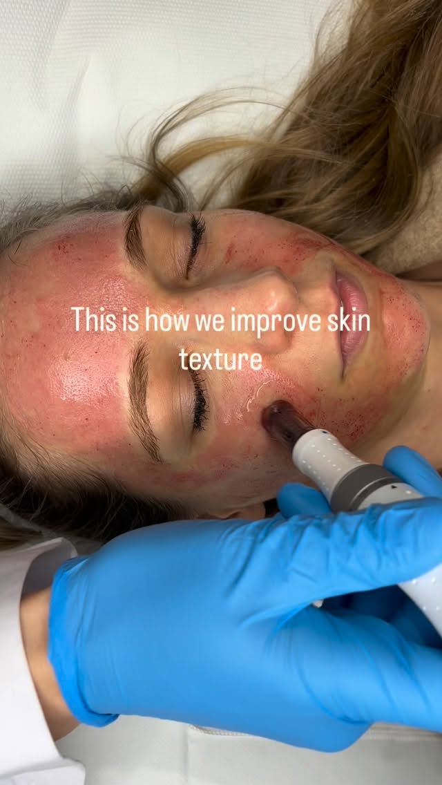 Microneedling is one of the most effective ways to improve skin texture by stimulating your own collagen.
Think smoother, more refined, healthier-looking skin over time🌟
If your skin feels uneven, dull or textured… this is where we start👩🏼⚕️
@imedpen_microneedling
Book via link in bio🔗
#collagen #collagenbanking #skin #naturalbeauty skinhealth