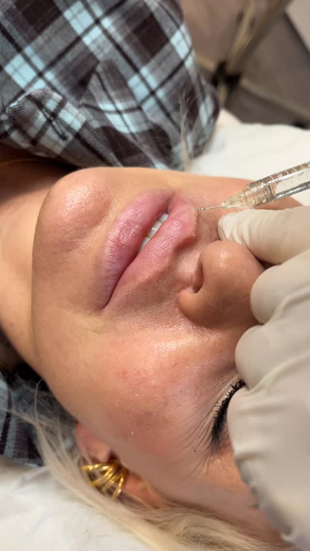 Lips lips lips ❤️❤️❤️ #athlone #lipfiller
