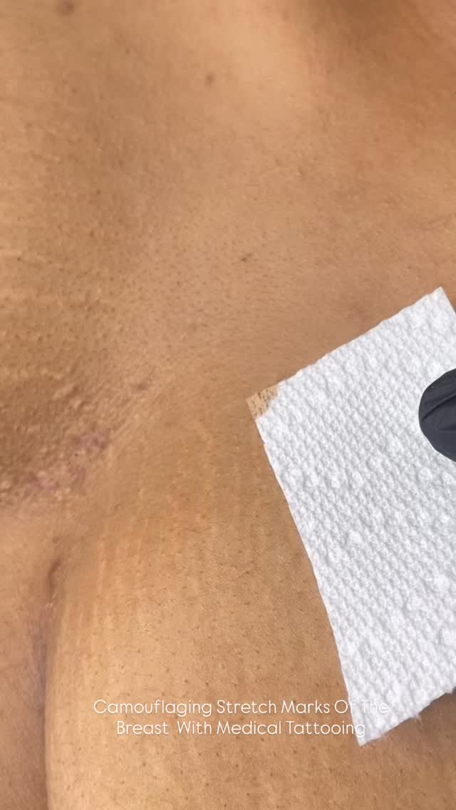 Now Booking Consultations & Appointments for Stretch Mark Camouflage @beatandblade
BEATANDBLADE.COM
#medicaltattoo #stretchmarkcamouflage #paramedicaltattoo #tattoo #tattooartist