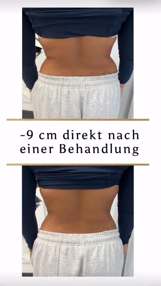 ✨ Fett reduzieren, ganz ohne OP? Ja, das ist möglich!‼️✨
Du störst dich an hartnäckigen Fettpolstern an deinen Fesseln und wünschst dir eine schlankere, definiertere Silhouette? 💫
Bei uns kannst du genau das erreichen – ohne Schnitte, ohne Ausfallzeit und ohne OP.
💎 Deine Vorteile auf einen Blick:
✔️ sichtbare Reduktion schon nach nur einer Behandlung möglich
✔️ keine Narben, keine Verletzungen
✔️ kein Tragen von Kompressionskleidung
✔️ direkt zurück in deinen Alltag
✔️ langanhaltende Ergebnisse bei gesunder Lebensweise
Stell dir vor: Du ziehst deine Lieblingsschuhe an und fühlst dich endlich rundum wohl in deinem Körper… 😍
👉 Jetzt ist der perfekte Moment, etwas für dich zu tun.
Warte nicht länger und starte deine Transformation noch heute.
📩 Schreib uns eine DM oder sichere dir direkt deinen Termin – wir beraten dich individuell!
#körperformung #fettreduktion #vorhernachher #beautytreatment #fettabsaugung