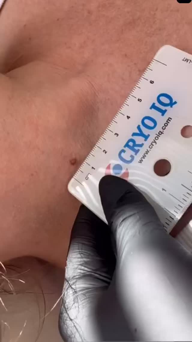 Unwanted lumps and bumps? We’ve got you! ❄️
What can be treated?
- Warts
- Age spots
- Hyperplasia
- Verruca
- Skin Tags
- Moles
- Pigmentation
- Seborrheic Keratosis
Our medical grade device CryolQ uses nitrous oxide to freeze and destroy the tissue of unwanted lesions on the face and body. 🩵
📍London Road Clinic: 65 London Road, Newark NG24 1RZ
📞 01636 680767
📧 hello@londonroadclinic.com
🔗 Booking link in bio